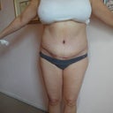 10 days post-op.