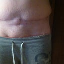 Here's my 5month post op photo...I am seeking a second opinion at this point. My result is being blamed on my weight (which is 9lbs lighter than preop). I am not gaining weight and I am exercising. After expressing concerns to my PS he requires a 21lb weight loss. I'm feeling very discouraged. 10 lbs? ok! 21lbs I will be a skeleton no thanks. I am also concerned because my incision is higher than all of my pants underwear and bathing suits. PS said the scar will magically lower after I reach the unattainable 21lbs. I'm cornered.