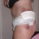 3 days post op, side view