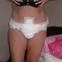 3 days post op front view