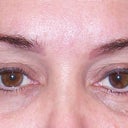 Exactly one month later the same circles are visible again and the blueness has not disappeared under one eye.