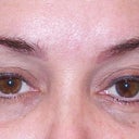 Exactly one month later the same circles are visible again and the blueness has not disappeared under one eye