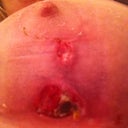 Hoping this will heal with minimal scarring
