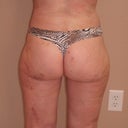 2  1/2 weeks postop