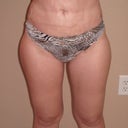2  1/2 weeks postop