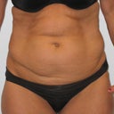 Pre abdomen picture