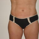 Post Abdomen picture