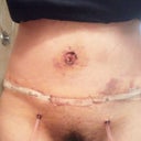4 days PO...Scar is low, some bruising, little swelling.