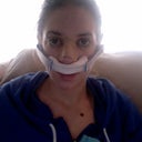 This is either day 2 or 3 after surgery. I had hardly any bruising!