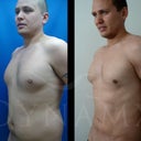 4D Lipo With Fat Transfer To Pectorals