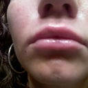 right after the injections.. red and swollen