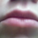lips the night before the injections