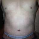 17 days post-op
