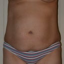 Mommy Makeover pre-op. Frontal view! May not be suitable for the squimish. :O)