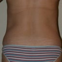 Mommy Makeover pre-op. Rear view! Ahhhhhh!