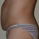 Mommy Makeover pre-op. And my favorite... NOT!! The side view!