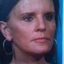 After at around 6months and botox on the forehead though the botox did make my lids a little heavy it has worked as an alternative to a brow lift