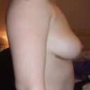 After explant, 4 days post-op
