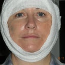 Right after surgery