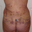 back with serious swelling