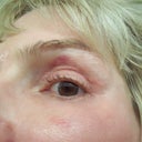 The only marks left are a red mark under my left eye and on my left cheek. The marks cover fairly well with make-up. I bruise easily, but scars fade very well on me.
