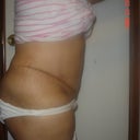 8 days post surgery right side