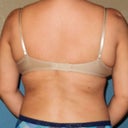 Here is an after with my bra on. I can still see some roll but not half as bad as what it was before the procedure.