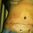 my pubic area was pulled up so high it is now 2 inches above my pant line the tattoo used to be where the drains are