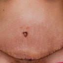 Day 11 post op. TT scar.