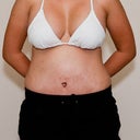 Day 11 post op.