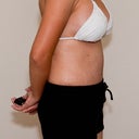 Day 11 post op.