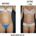 Before pic on left- 1 day post op on right