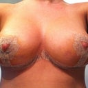 8 days post op