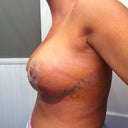 Side 8 days post op