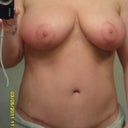 13 weeks...scar is very low.