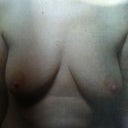 Before breast augmentation. Yuck!!!