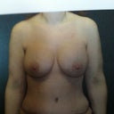 After augmentation. Much better!!