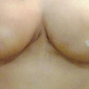 11 days post-op! i had a piece of surgical tape on my left boob