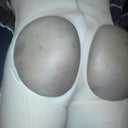 swollen and bruised