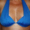 3 weeks post-op.  My boobs are amazing...if I do say so myself.  What a difference!!!