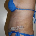 3 weeks post-op side view. I'm still swollen but it's improving every day.