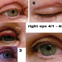 right eye progression thru 14 days post op.