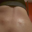 The incisions on my waist 24 hours later.