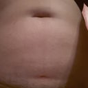 The incisions on my bikini line 24 hours later! :-)