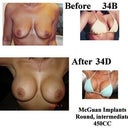 2005 surgery 450cc moderate saline implants
