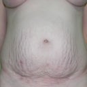 2 Days Pre-op
