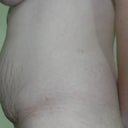 2 Days Pre-op