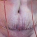 3 Days Post-op
