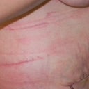 3 Days Post-op