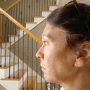 side view of jowls and laxity of my skin